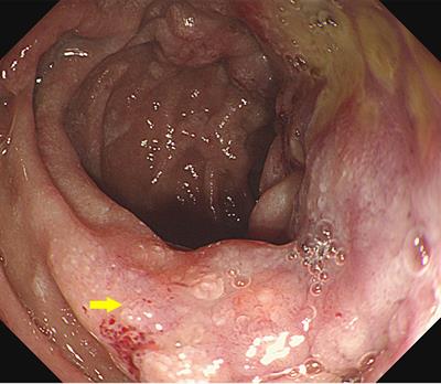 Poorly cohesive duodenal carcinoma mixed with signet ring cell carcinoma with systemic metastasis: a case report and literature review